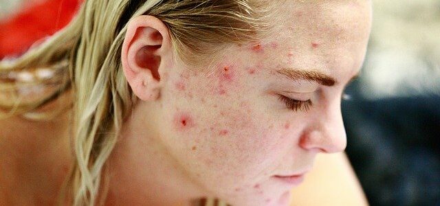 L’acide hyaluronique provoque-t-il de l’acné ?